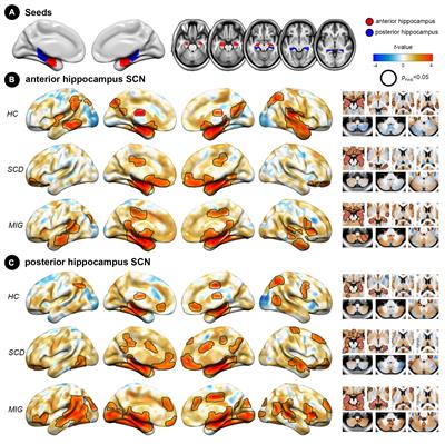Shared alterations in hippocampal structural covariance in subjective cognitive decline and migraine